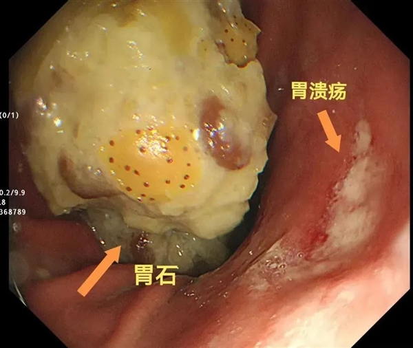 男子山楂和栗子一起吃 胃里长出8厘米石头